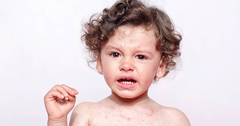 Wysypka u dziecka – o czym może świadczyć? Przyczyny i leczenie wykwitów skórnych u dzieci