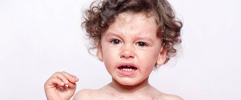 Wysypka u dziecka – o czym może świadczyć? Przyczyny i leczenie wykwitów skórnych u dzieci