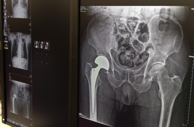 Endoproteza biodra – wskazania do wykonania endoprotezoplastyki stawu biodrowego. Przebieg operacji, rekonwalescencja, rehabilitacja