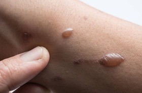 Pemfigoid – co to za choroba skóry? Dlaczego pojawia się u ciężarnych? Jak ją rozpoznać i leczyć?