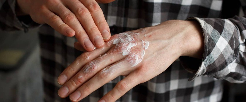 Łuszczyca – czym jest i jak się ją leczy? Jak pielęgnować skórę łuszczycową?