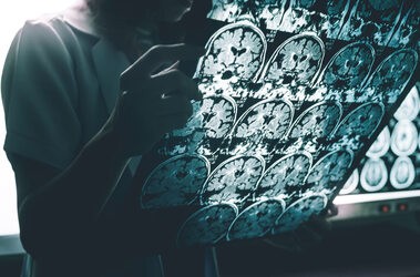 Lekarz odczytuje rezonans magnetyczny mózgu pacjenta z chorobą Alzheimera