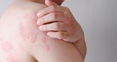 pokrzywka, pokrzywka skórna, pokrzywka alergiczna, alergia skórna