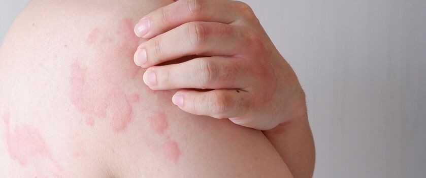 pokrzywka, pokrzywka skórna, pokrzywka alergiczna, alergia skórna