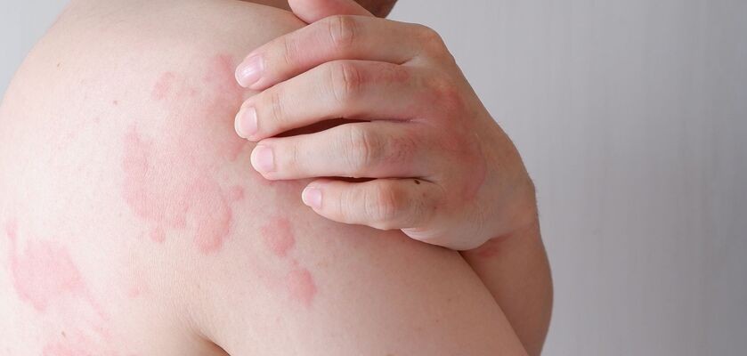 pokrzywka, pokrzywka skórna, pokrzywka alergiczna, alergia skórna