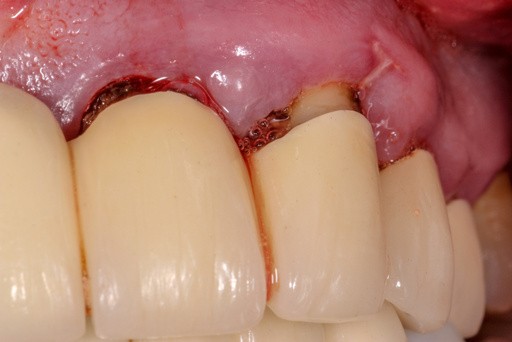 zdjęcie zębów w paradontozie