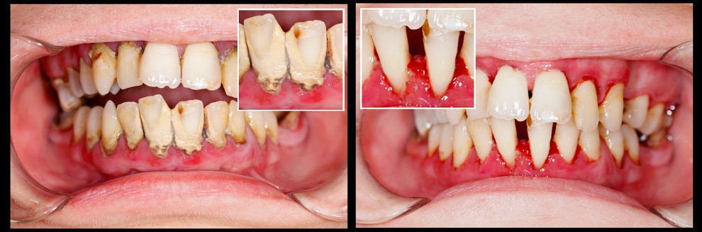 zdjęcie zębów przed i po leczeniu paradontozy