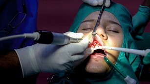 zdjęcie operacji resekcji korzenia zęba