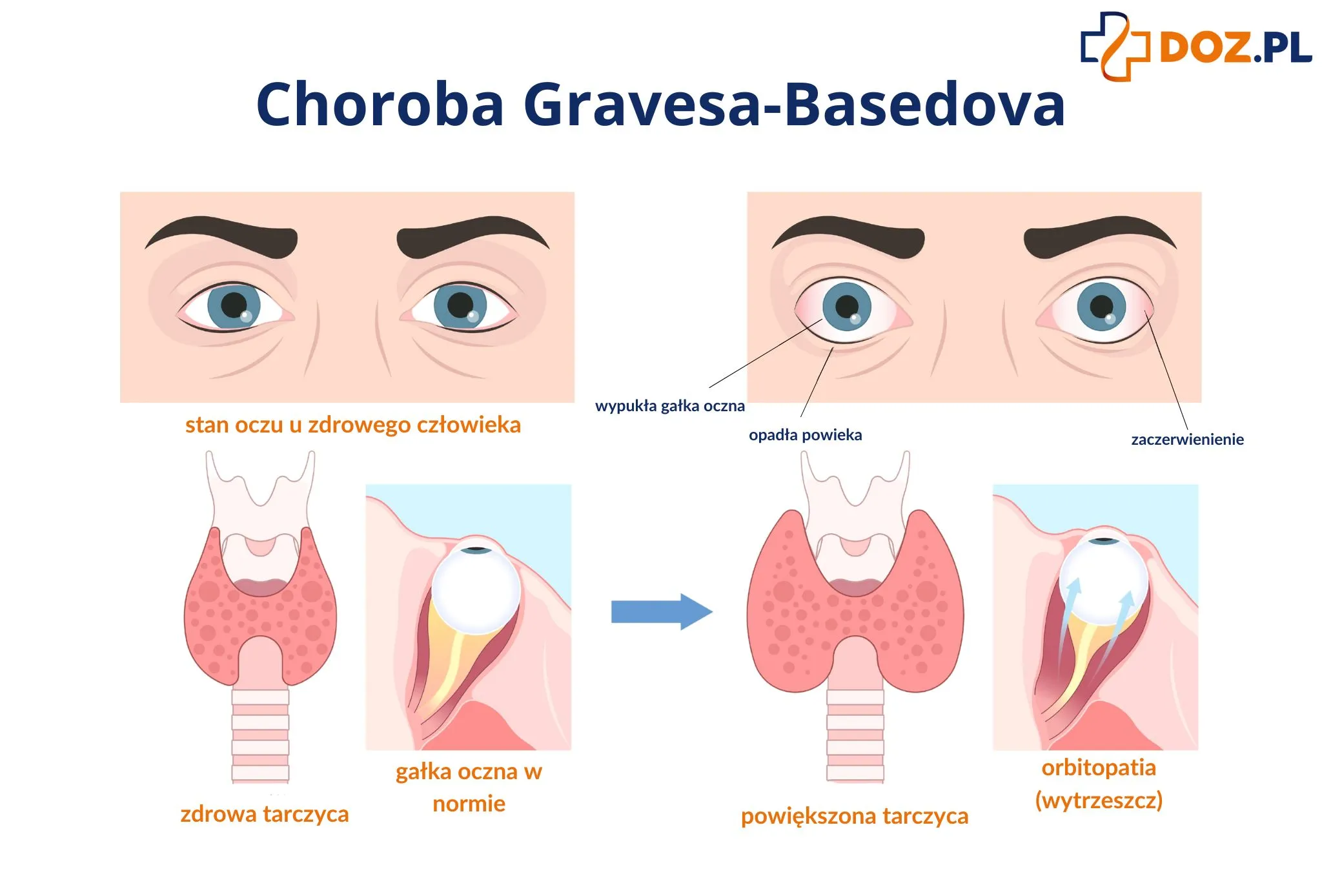 Choroba Gravesa-Basedova - objawy