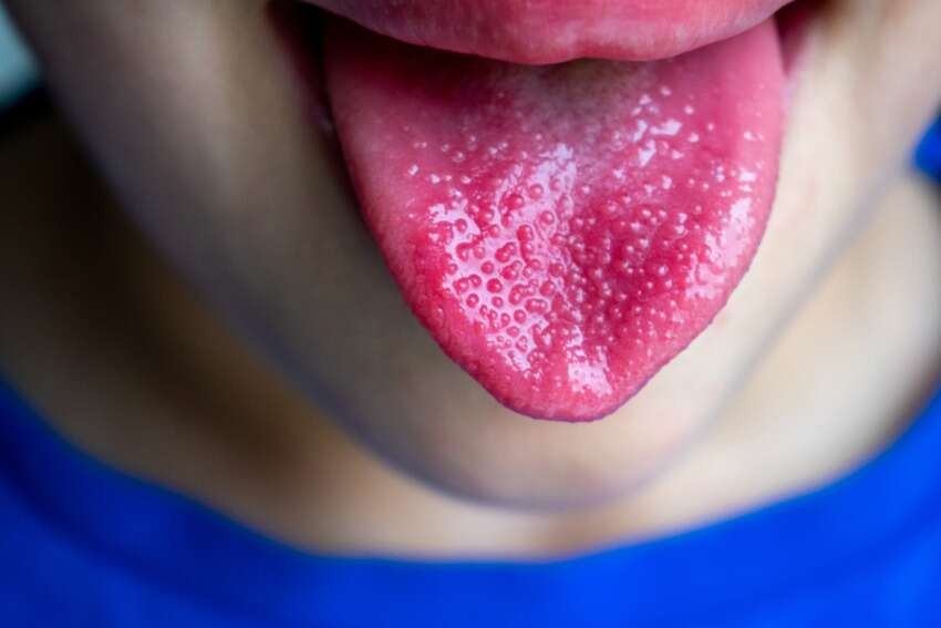 Szkarlatyna dotyka najczęściej dzieci w wieku szkolnym. "Malinowy język" to jeden z objawów infekcji.