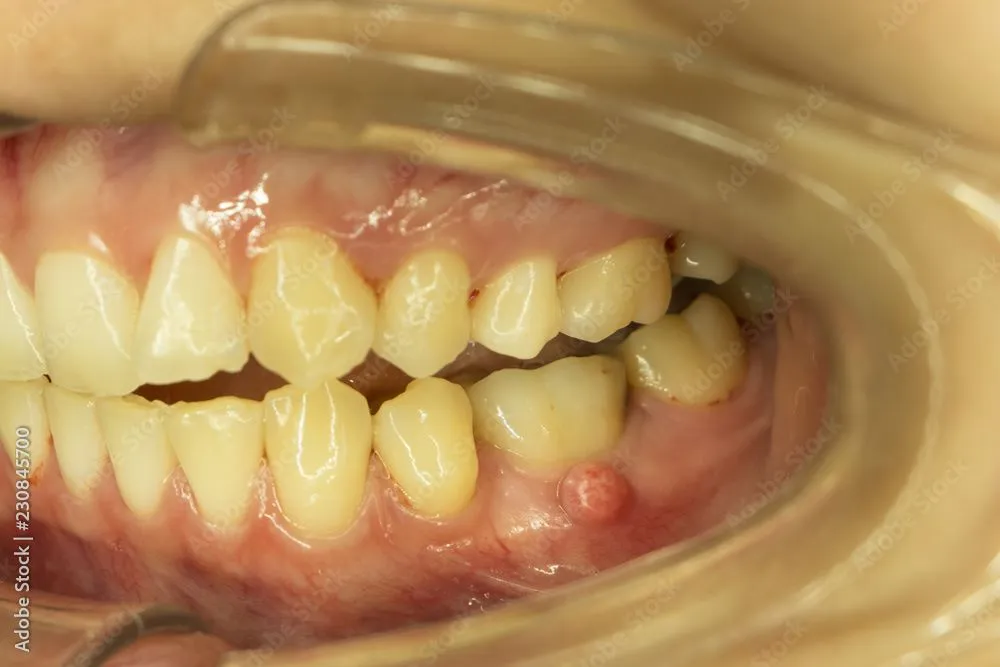 Jak wygląda ropień zęba?