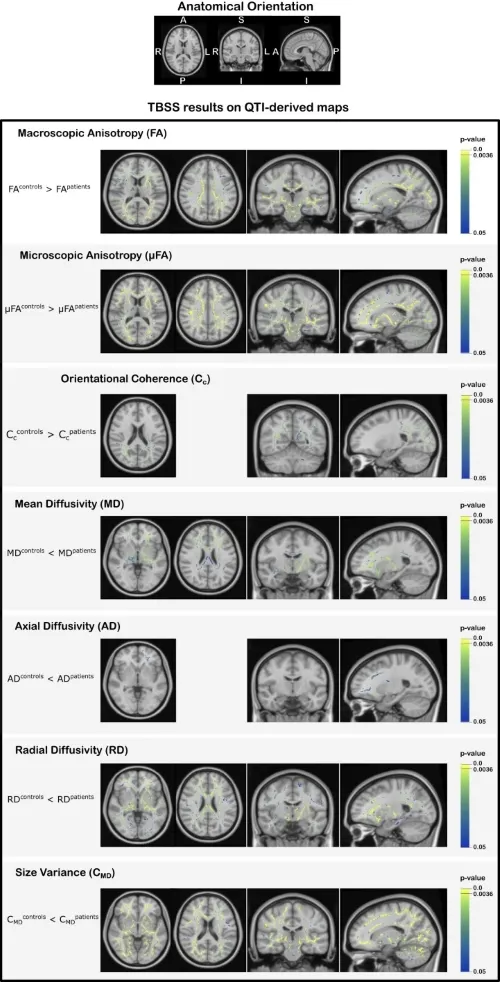 Zdjęcia z Dyfuzyjnego rezonanansu magnetycznego mózgu