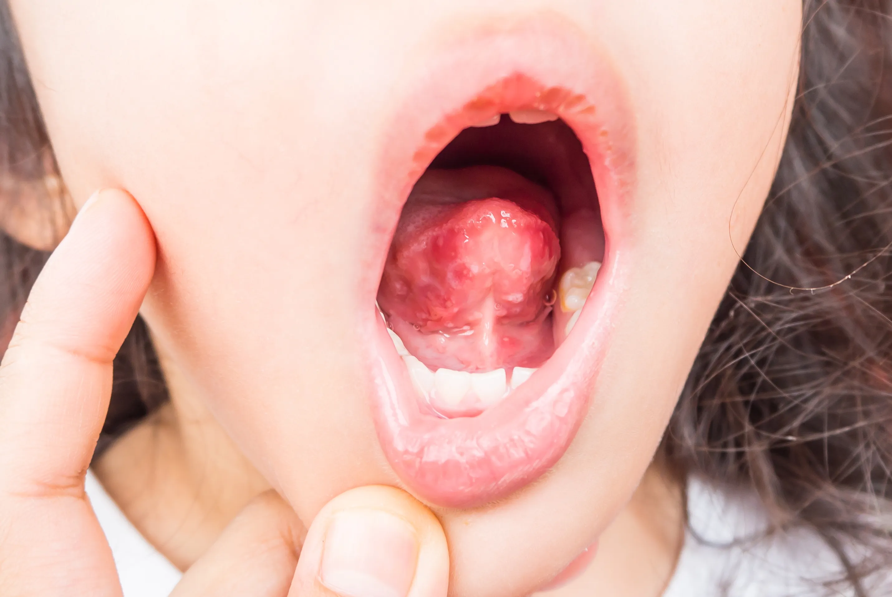 Objawy bostonki wewnątrz jamy ustnej (buzi)