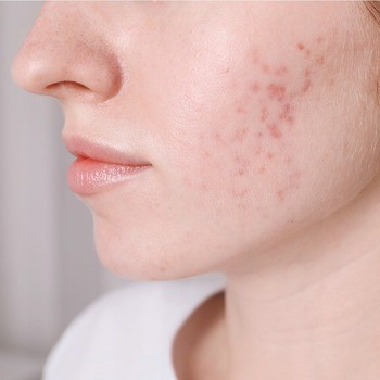 Idee Derm, serum zwalczające trądzik z kwasami, 30 ml
