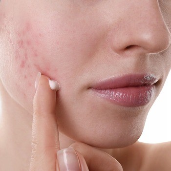 Idee Derm, krem niwelujący niedoskonałości z kwasem salicylowym, 50 ml