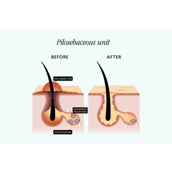 Solve On AcneKrem, krem z kwasem azelainowym 10%, 30 ml