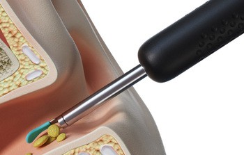 Bebird EarSight R1, otoskop z kamerą do czyszczenia uszu, biały, 1 szt.