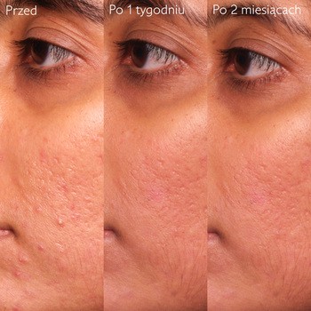 Caudalie Vinopure, serum na niedoskonałości z kwasem salicylowym, 30 ml