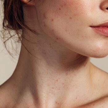 Bielenda SheCare, probiotyczna emulsja do ciała łagodząca zmiany potrądzikowe, 225 ml