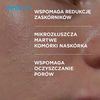 Idee Derm, serum zwalczające trądzik z kwasami, 30 ml