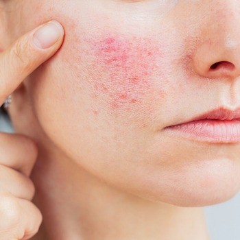 Idee Derm, dermatologiczny tonik mikrozłuszczający, 220 ml